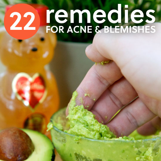 22 Natural Home Remedies for Acne & Pesky Pimples